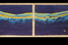Macula